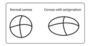 astigmatism